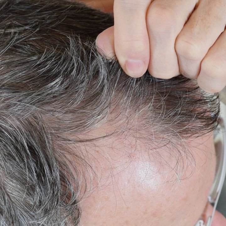 Tricotilomanía o arrancarse el pelo
